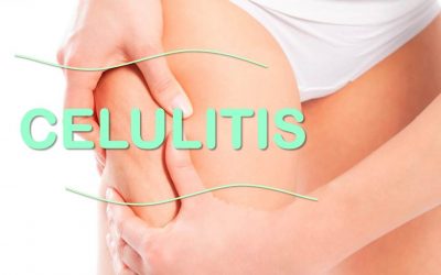 Celulitis