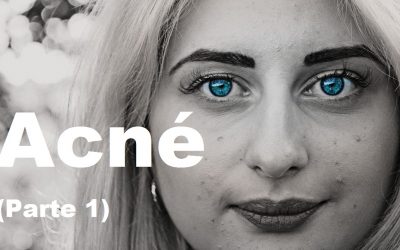 Acné (Parte 1)