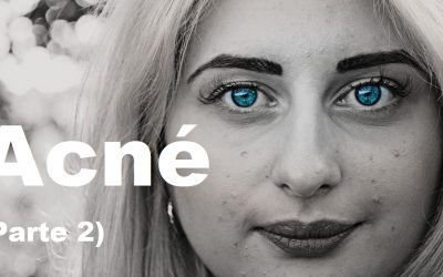 Acné (Parte 2)